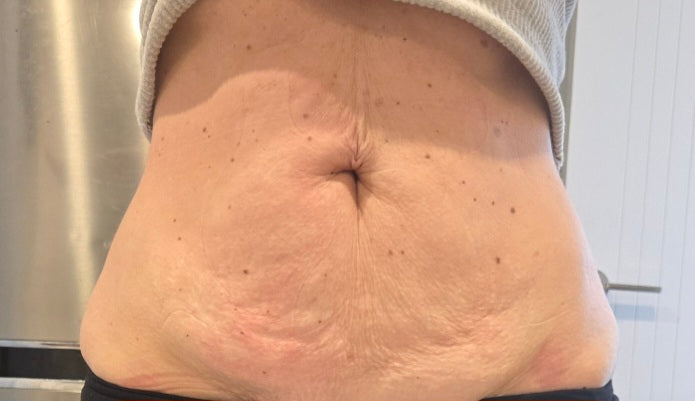 Ultimate Tummy Make Over Body Sculpting Auckland