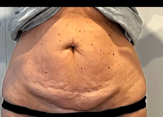 Ultimate Tummy Make Over  Body Sculpting Auckland