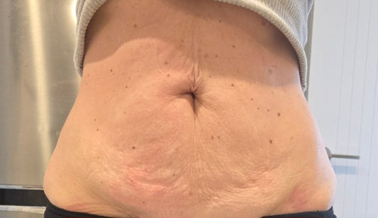 Ultimate Tummy Make Over  Body Sculpting Auckland